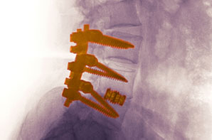 Spinal Implant Constructs
